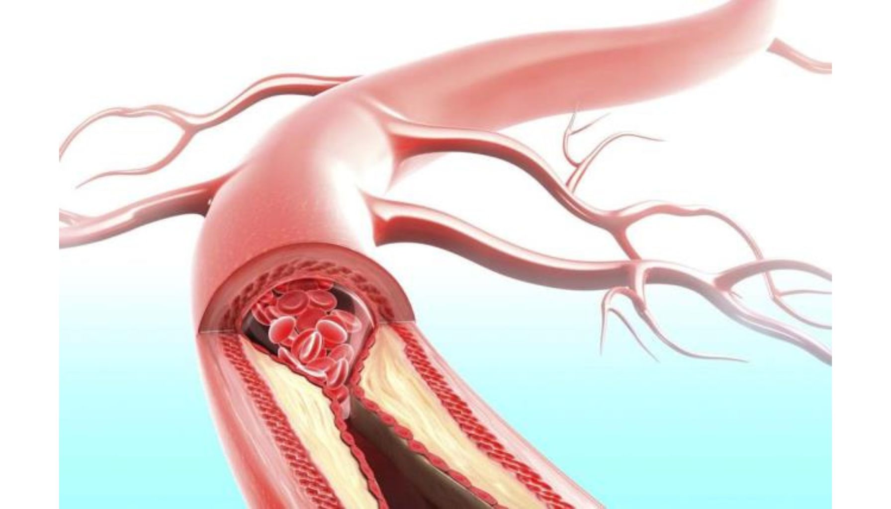 تصلب شرائین