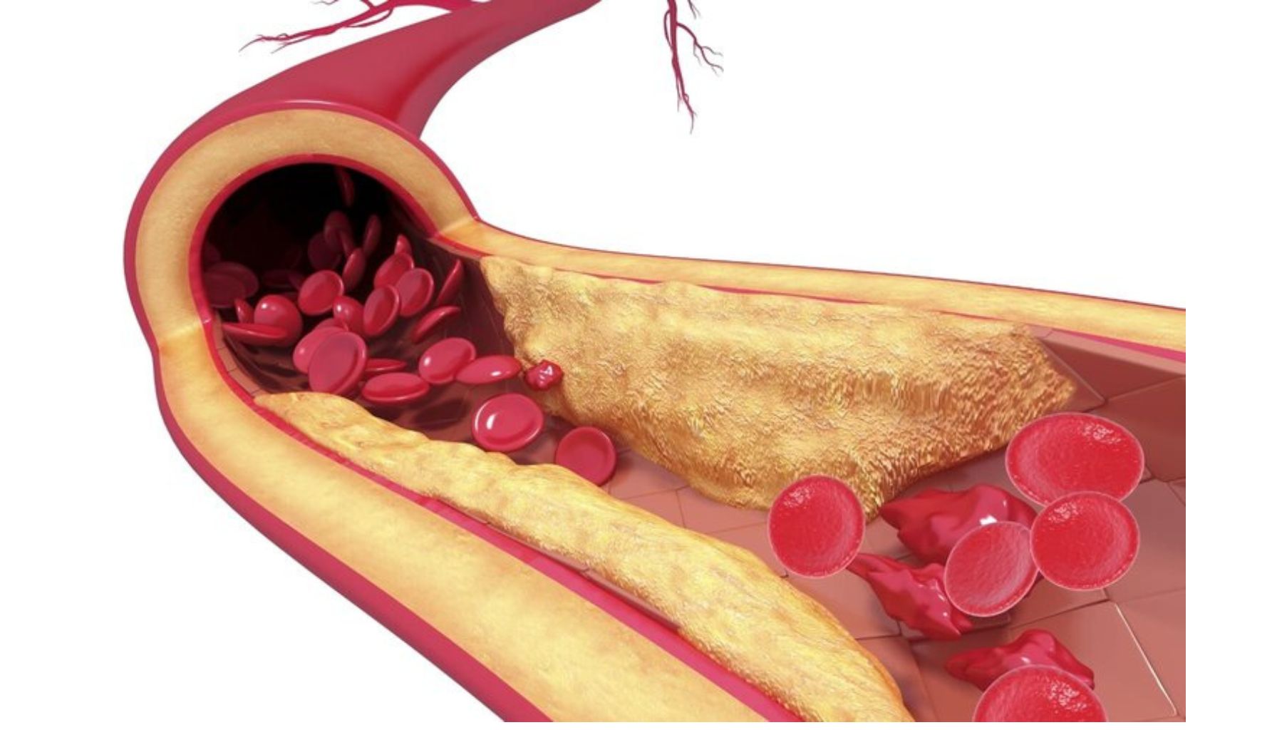 تصلب شرائین