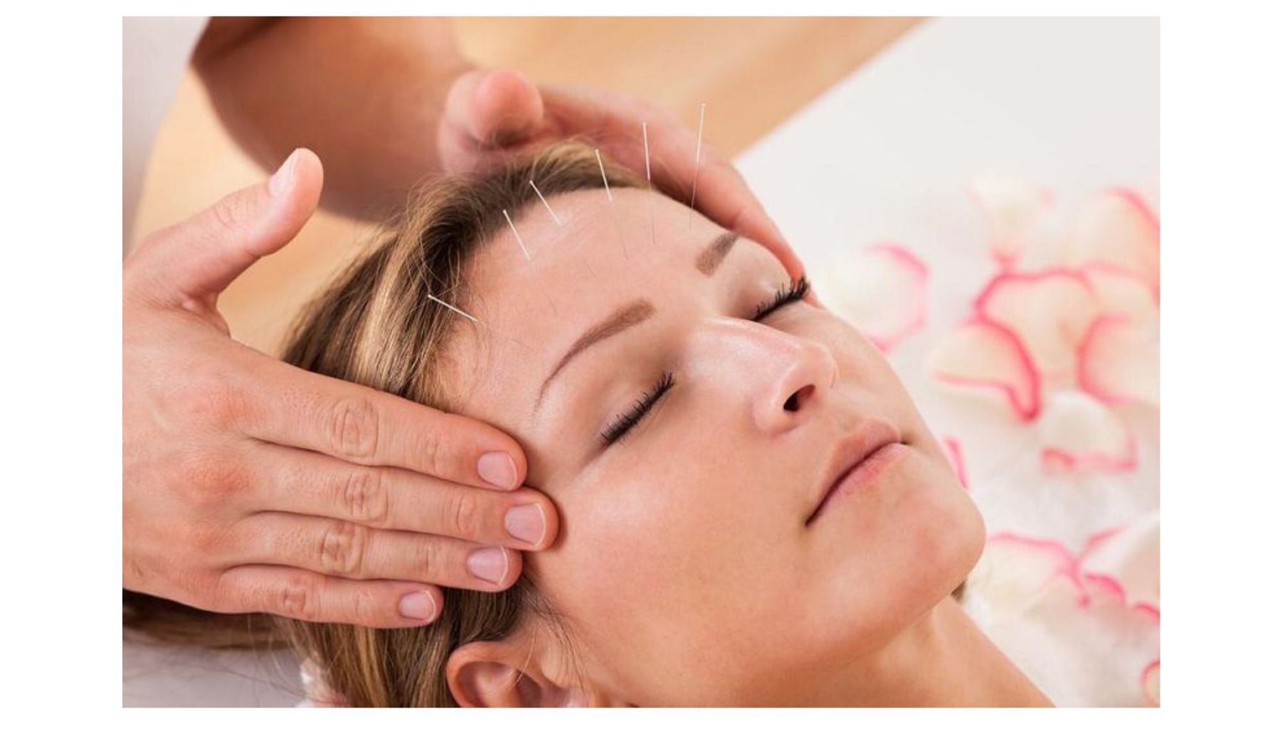 طب سوزنی و درمان سردرد