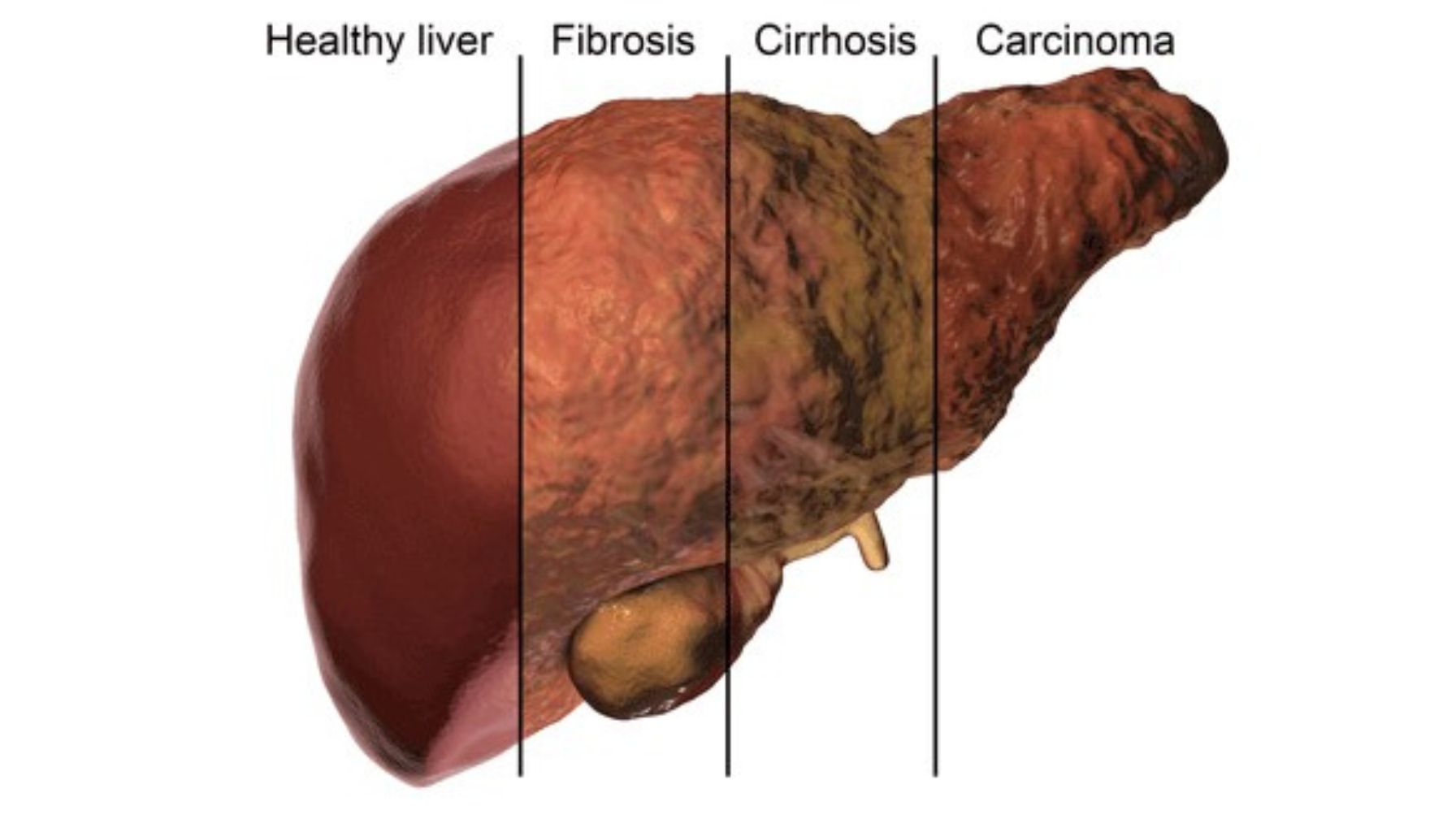 مراحل بیماری کبد چرب