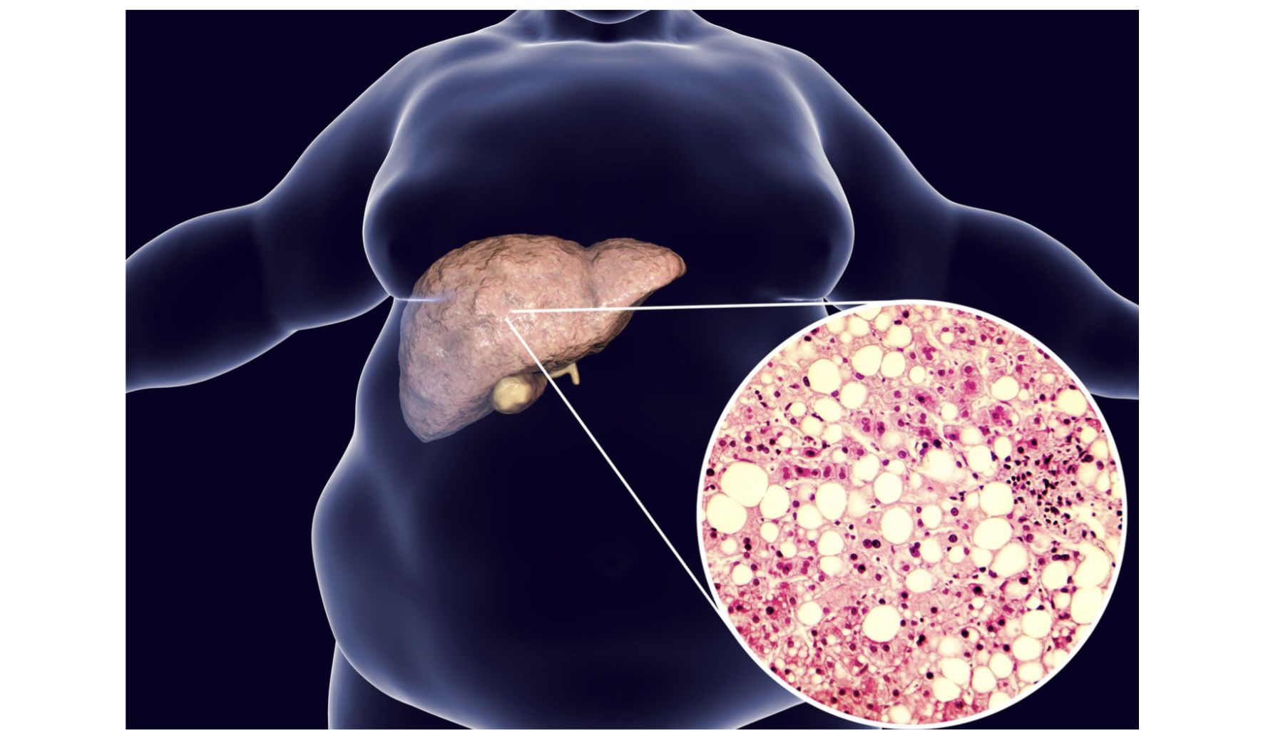 علل کبد چرب